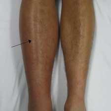Dvt Lidmaat